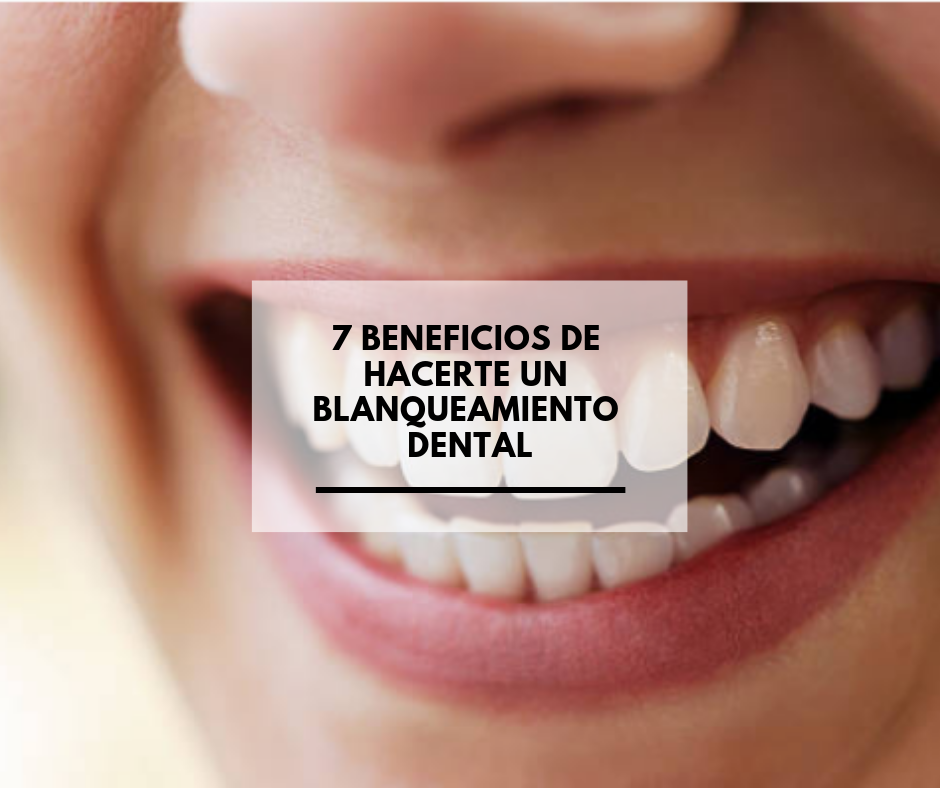 7 beneficios de hacerte un blanqueamiento dental